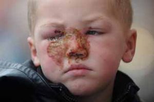 Numa festa familiar um menino de 3 anos ficou queimado